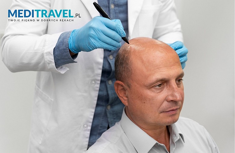 Przeszczep włos&oacute;w